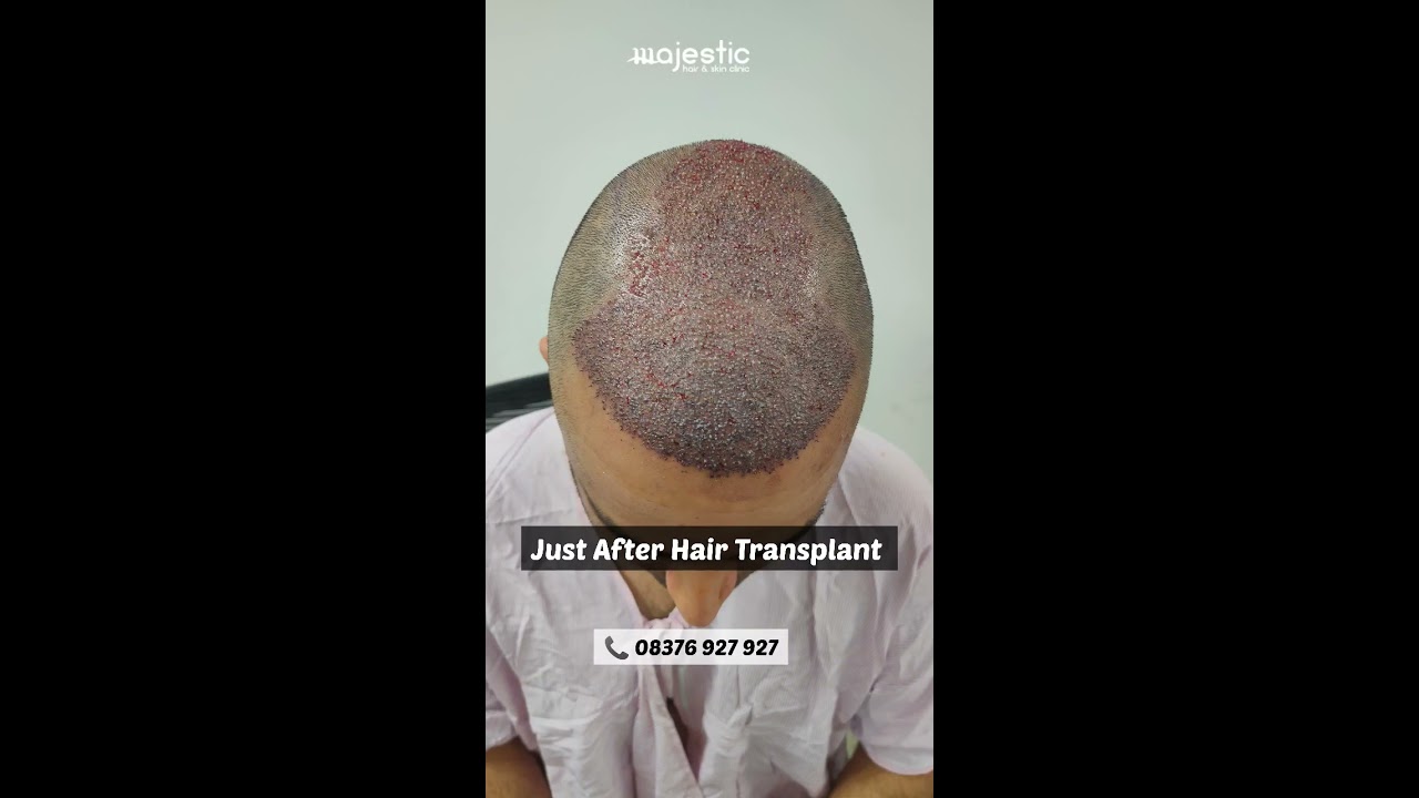 How Does The Hair Look Within 10 Days Of Transplant 08376927927 Prp Hairloss Baldness
