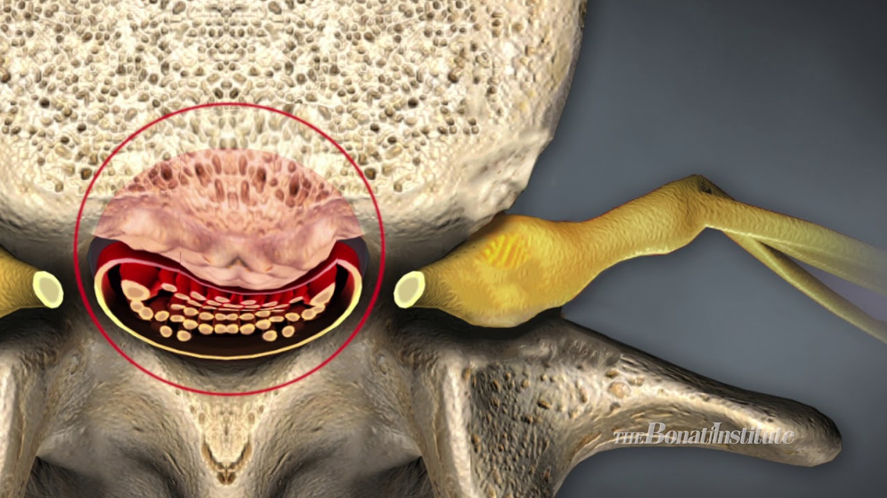 Spinal Stenosis causes, symptoms and treatment - Truspine