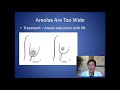 How Can I Fix Wide Areolas - Areola Surgery Consultation - Dr. Anthony Youn