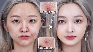 Acne skin for 15 years🤬 Best acne cover makeup🔥 Pigmentation and acne w/scar, all covered👌