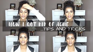 HOW I GOT RID OF ACNE | TIPS & TRICKS | THE LIFE OF B