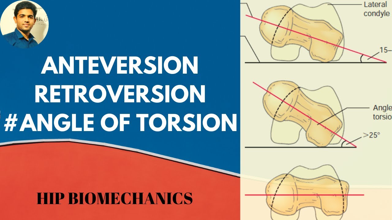 Anterversion Retroversion( Angle Of Torsion-Hip Biomechanics)