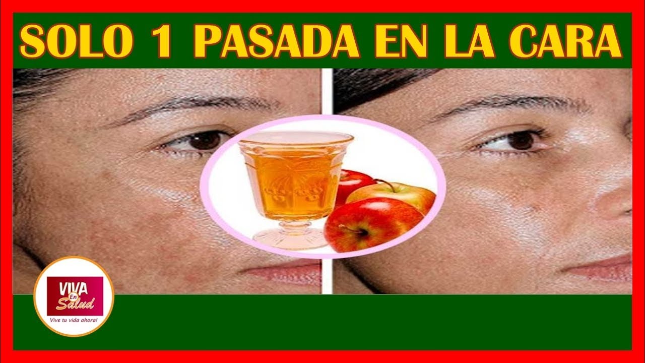 eczema nummular pdf Con 1 pasada de este vinagre en su cara, vea que pasa con las toxinas, eccema y manchas por la edad