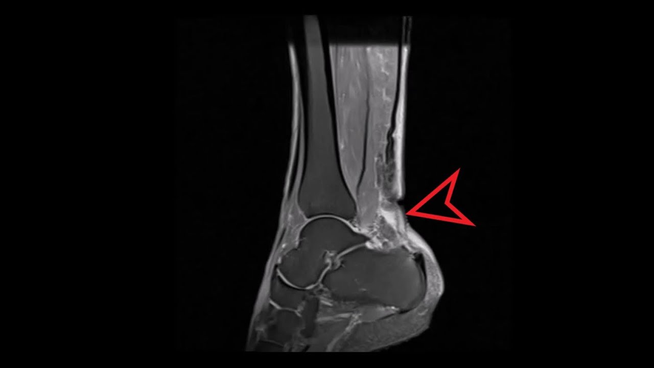 ankle-mri-achilles-tendon-tear-youtube