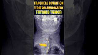 Thyroid Tumor