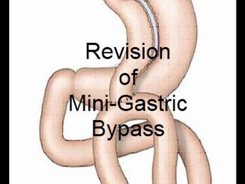 mini gastric bypass revision video dr rutledge mgb mini gastric bypass