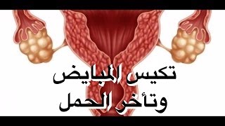 تكيس المبايض و تأخر الحمل