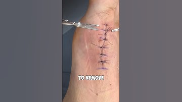 How to take stitches out! 😳(not medical advice) #shorts