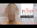 Patient Testimonial | My PCOD Journey - Acne Problem | Dr. Nivedita Dadu's Dermatology Clinic