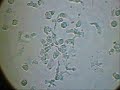 Cancro: Live cancer cell. Cellule cancerose in formazione (stadio Ca4) Oncogenesis