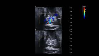 Ultrasound Shear Wave Elastography - Split Spinal Cord Malformation Post Spinal Cord Detethering.