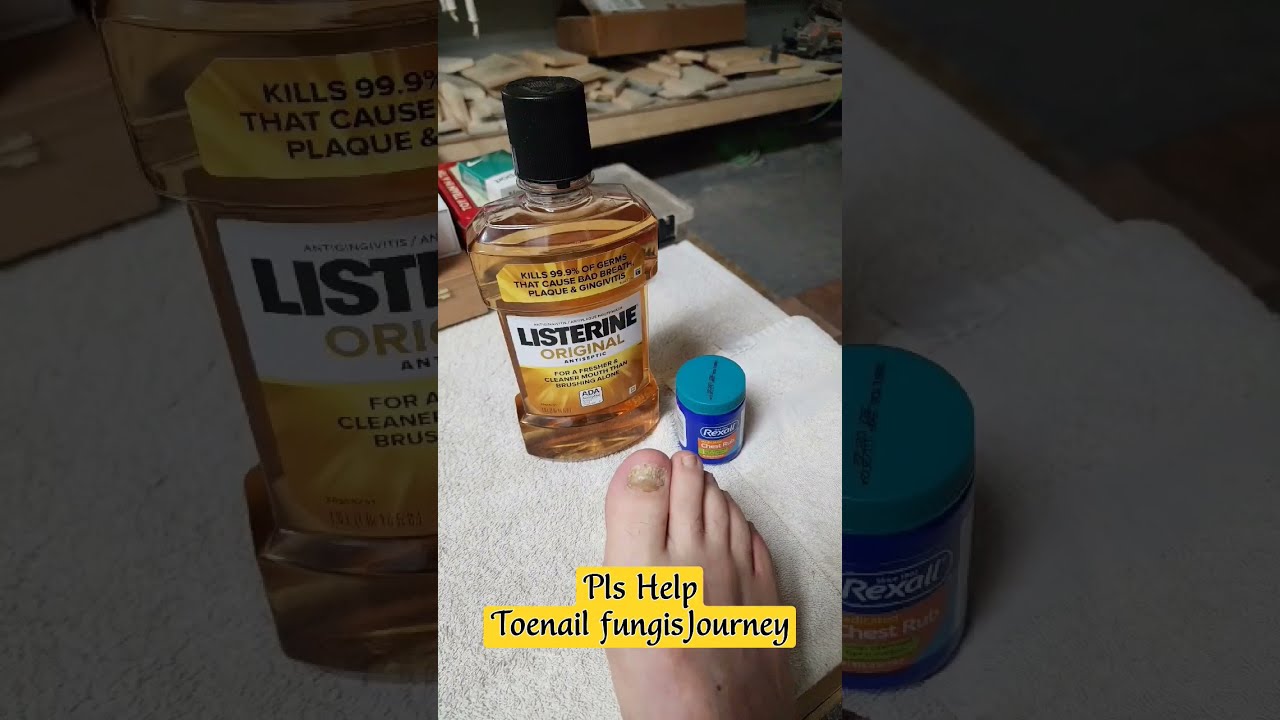 How To Treat Foot Fungus At Home Updated 3 17 24 Diy Toenailfungus Feet Toenails Toes