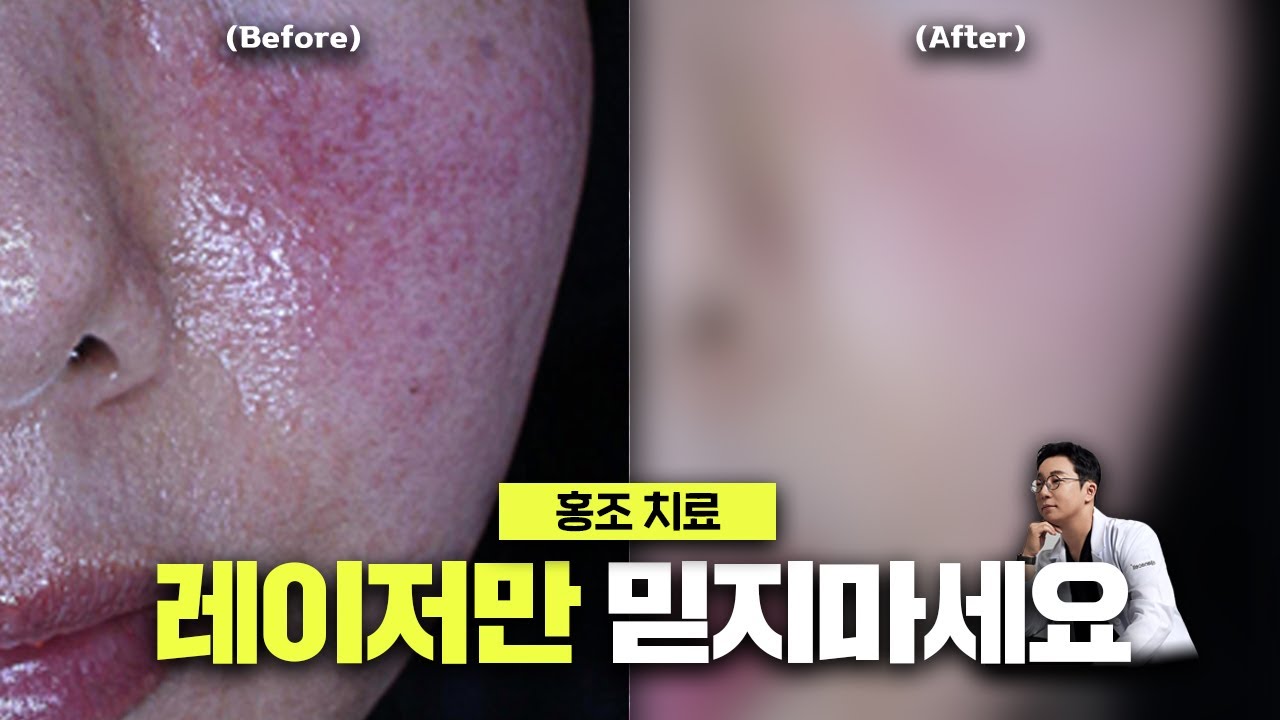 얼굴이 화끈거리고 붉어지는 안면 홍조의 원인과 올바른 치료법 / 얼굴 홍조 치료하는 법 - YouTube