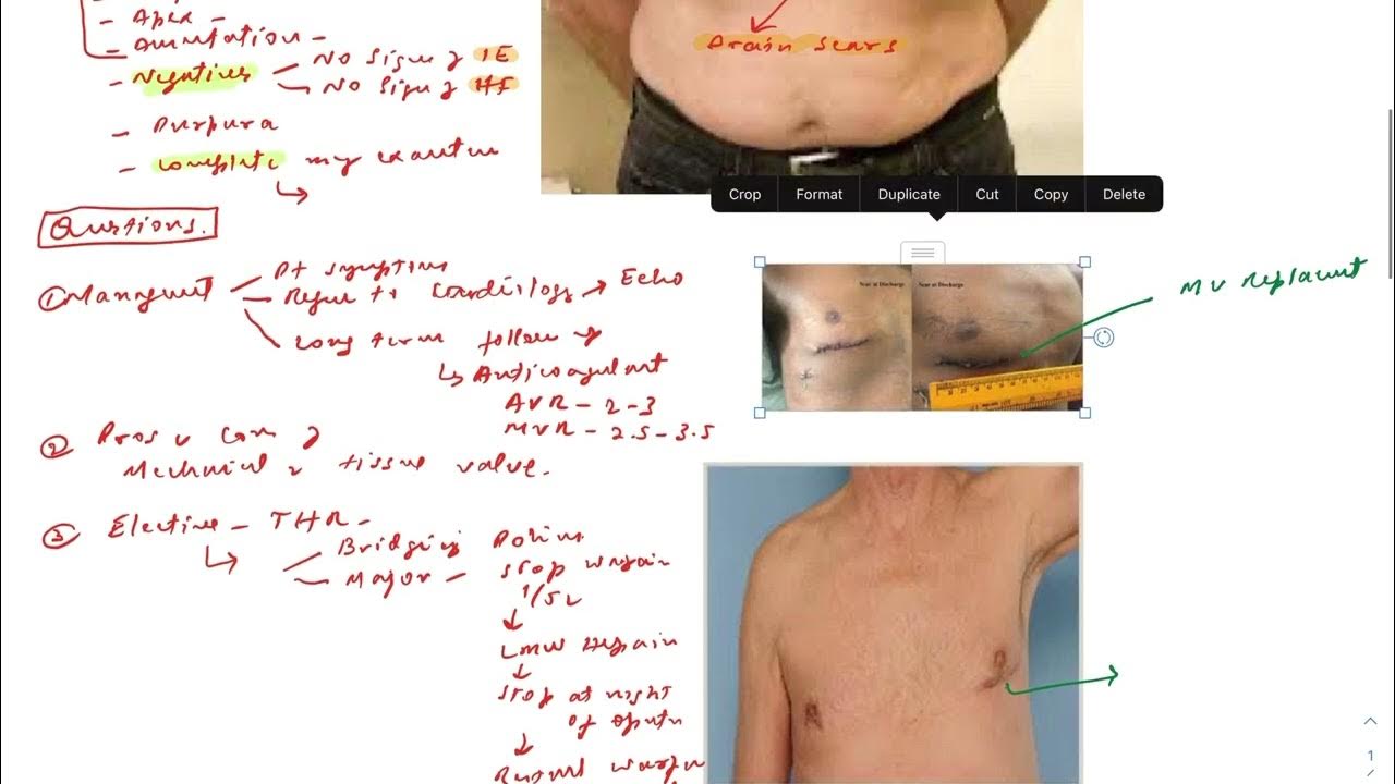 MRCP PACES CARDIOLOGY STATION. PROSTHETIC VALVE YouTube