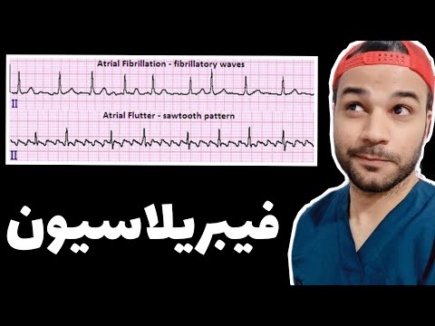 فیبریلاسیون دهلیزی   علایم مکانیسم تشخیص نوار قلب