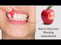 How to Stop Gum Bleeding Immediately with Natural Remedies!