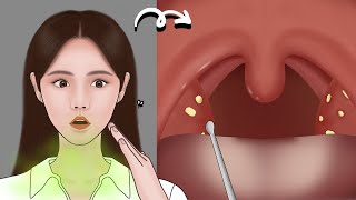 ASMR | What Caused Bad Breath? Satisfying white tongue & tonsil stones removal | Meng's Stop Motion