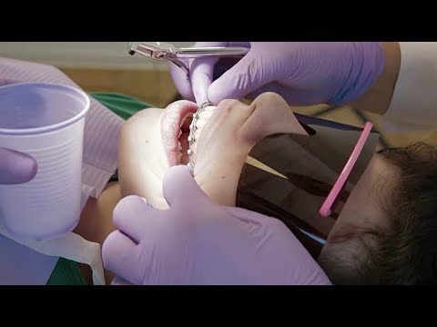 Video: Vorbereitung zum Entfernen der Zahnspange – wikiHow