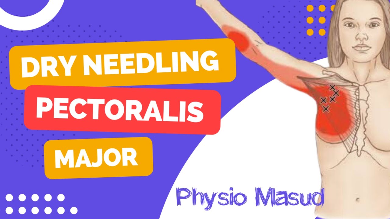 Pectodil Injection Dry needling on Pectoralis major, Trigger point therapy for Pectoralis ...