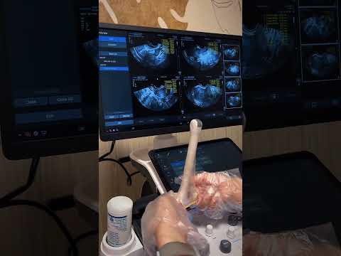 مراحل سونوگرافی واژینال جهت رویت قلب جنین ومشکلات رحمی سونوگرافی واژینال دکتر ابراهیمی سونوگرافی