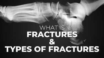 Types of bone fractures