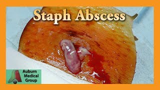 Staphylococcal Abscess | Auburn Medical Group