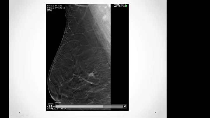 1- Mammography for FRCR (part 1) by dr. Amira Helal