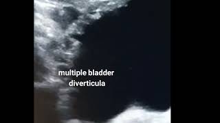 multiple bladder diverticula