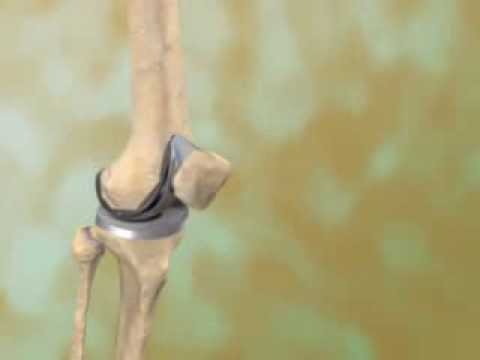 Total Knee Replacement