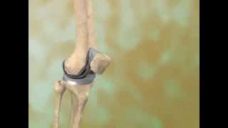 Total Knee Replacement