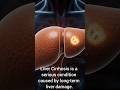 Causes of Liver Cirrhosis Explained | Fatty Liver, Alcohol &amp; Hepatitis/ Cirrhosis #livercirrhosis