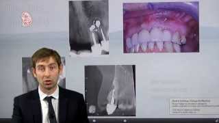 Implant is my backup option but endodontics really works.
