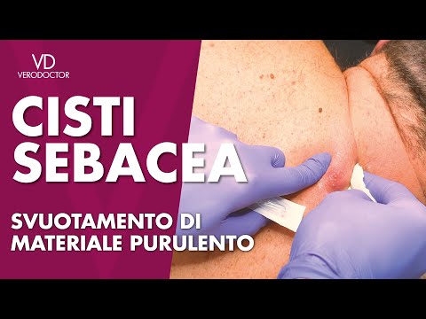 Video: Brufoli Alle Ascelle: Cause E Trattamenti