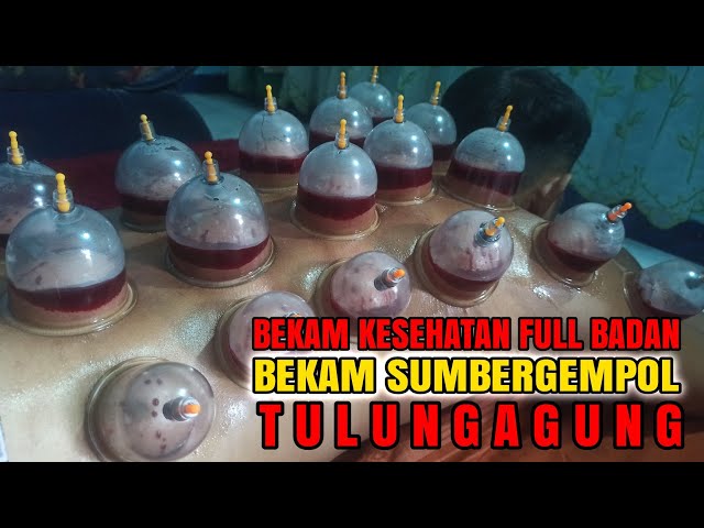 Bekam Tulungagung || Bekam Kesehatan || Bekam Full Badan || Bekam Sumbergempol class=