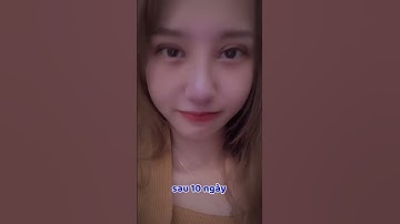 Nâng mũi cắt mí combo lột xác ❤️ #drdoanlam #nangmui #catmi