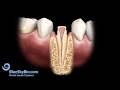 Patient Treatment Videos: Crowns