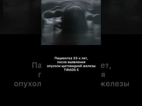 #узи #тиреоидэктомия