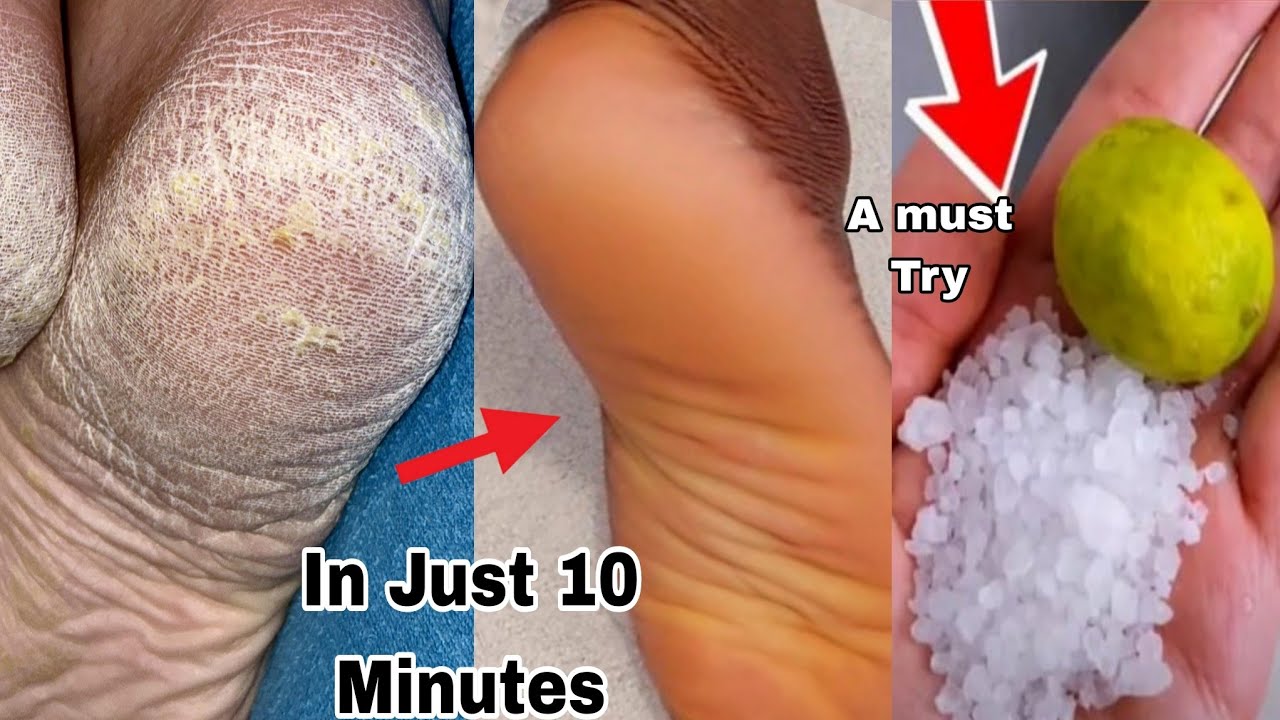 Как удалить омертвевшую кожу с ног естественными средствами в домашних условиях (2026) | Домашнее...