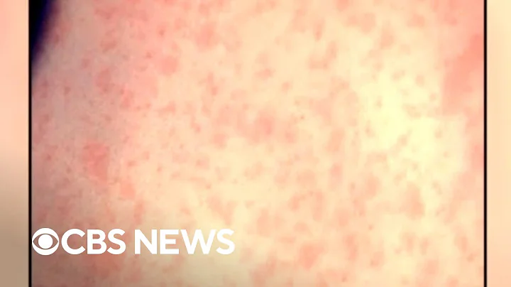 New alarming data on measles in the U.S.
