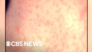 New alarming data on measles in the U.S.