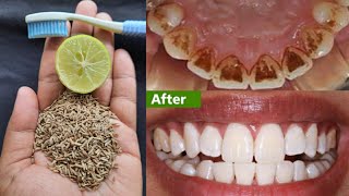 सिर्फ 3 मिनट में गंदे-पीले काले दाँतो को सफेद-चमकदार बना देगा / teeth whitening at home/dant safed