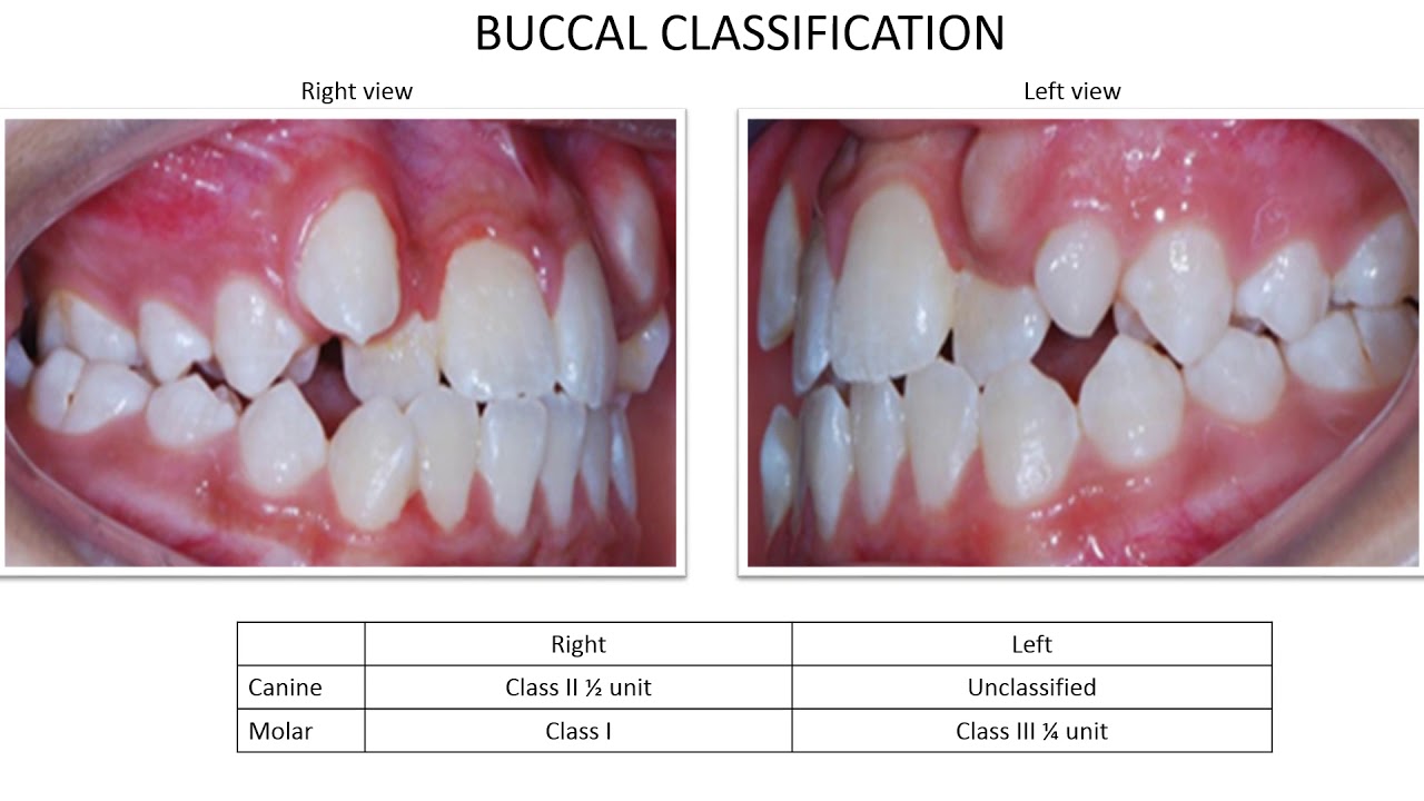 Orthodontic Case Presentation YouTube