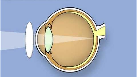 Retinoscopy of the eye (Ophthalmology)