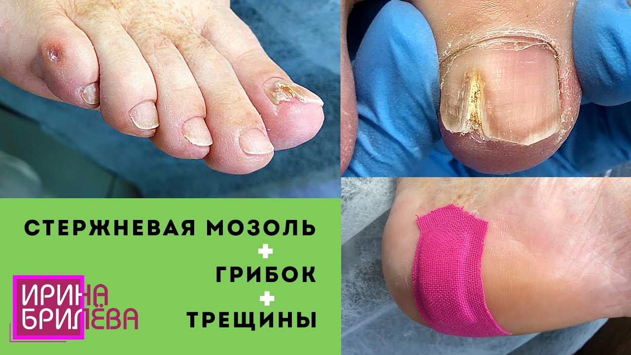 Стержневая мозоль удаление 🌸 Грибок ногтей 🌸 Трещины 🌸 Очень много ...