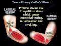 Tennis Elbow / Golfer's Elbow - Everything You Need To Know - Dr. Nabil Ebraheim