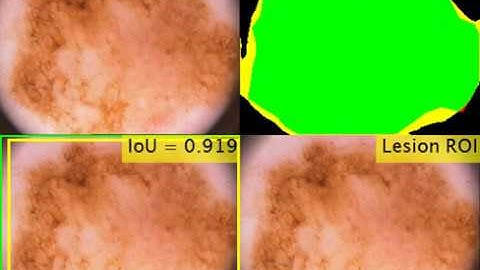 Segmentation Results Using DSNet on ISIC 2016