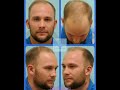 Dallas Hair Transplant Megasession Video Transformation