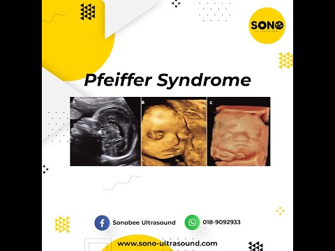 Sono Ultrasound: Pfeiffer Syndrome