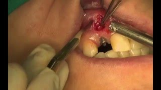 Amalgam Tattoo Clinical Features Incidence Etiology Diagnosis  Management  Dental Science