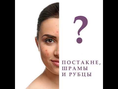 Крем от постакне Цикатрикс - YouTube